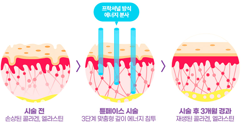 시술 전(손상된 콜라겐, 엘라스틴) -튠페이스 시술(3단계 맞춤형 깊이 에너지 침투)-시술 후 3개월 경과(재생된 콜라겐, 엘라스틴)